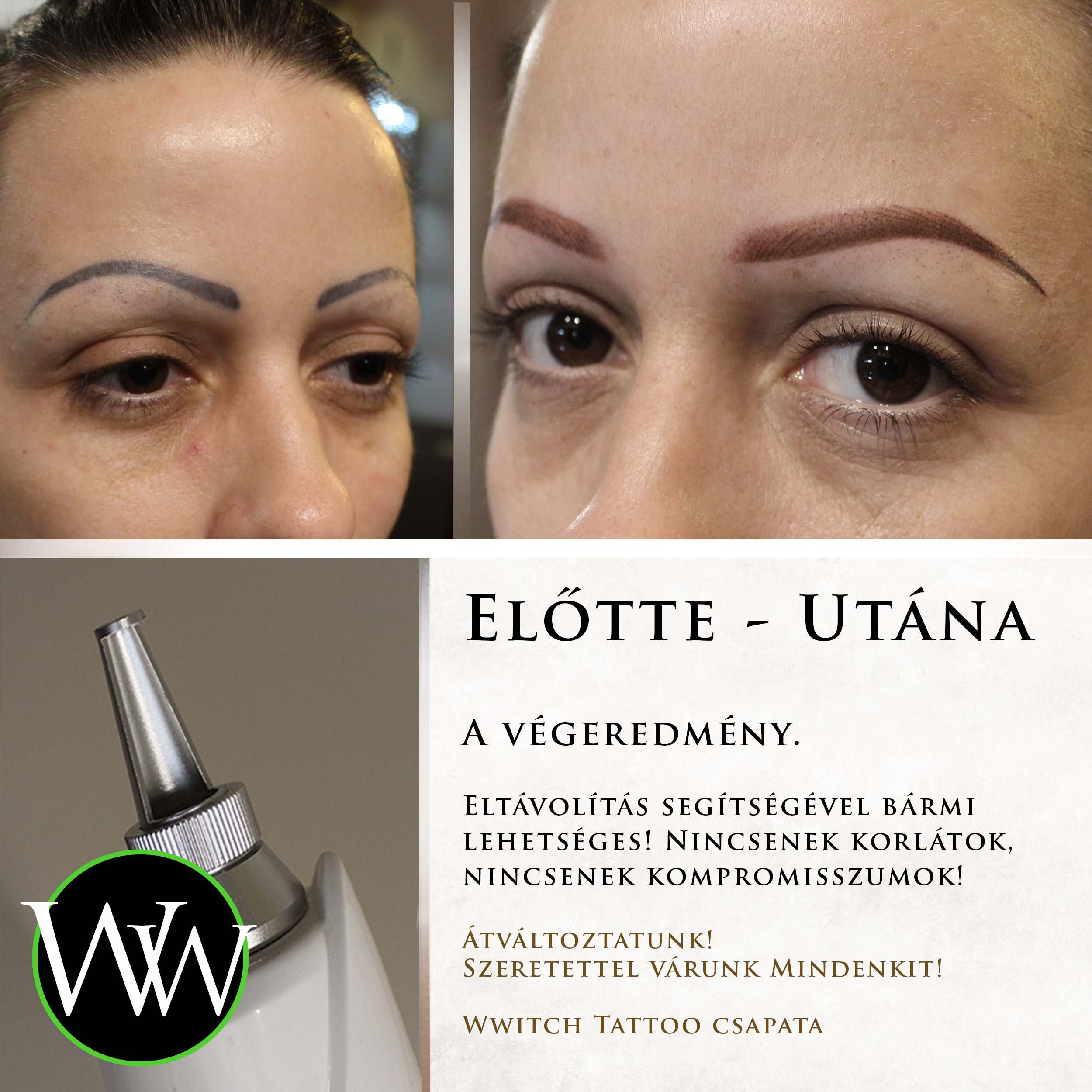 wwitchtattoo.removal.lepesek.7..